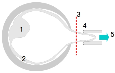 biopsie.jpg, 25kB