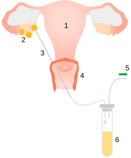 odber-oocytu.jpg, 48kB